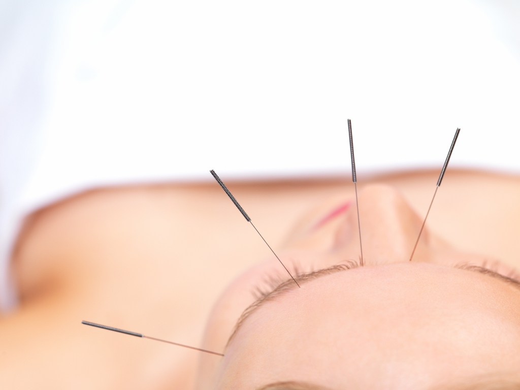 Acupuncture of the face